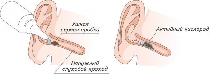 Как промыть уши перекисью водорода в домашних условиях и удалить серную пробку: инструкция пошагово, отзывы